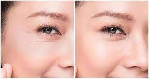 How to Get Rid of Eye Lines, Creases and Wrinkles ?